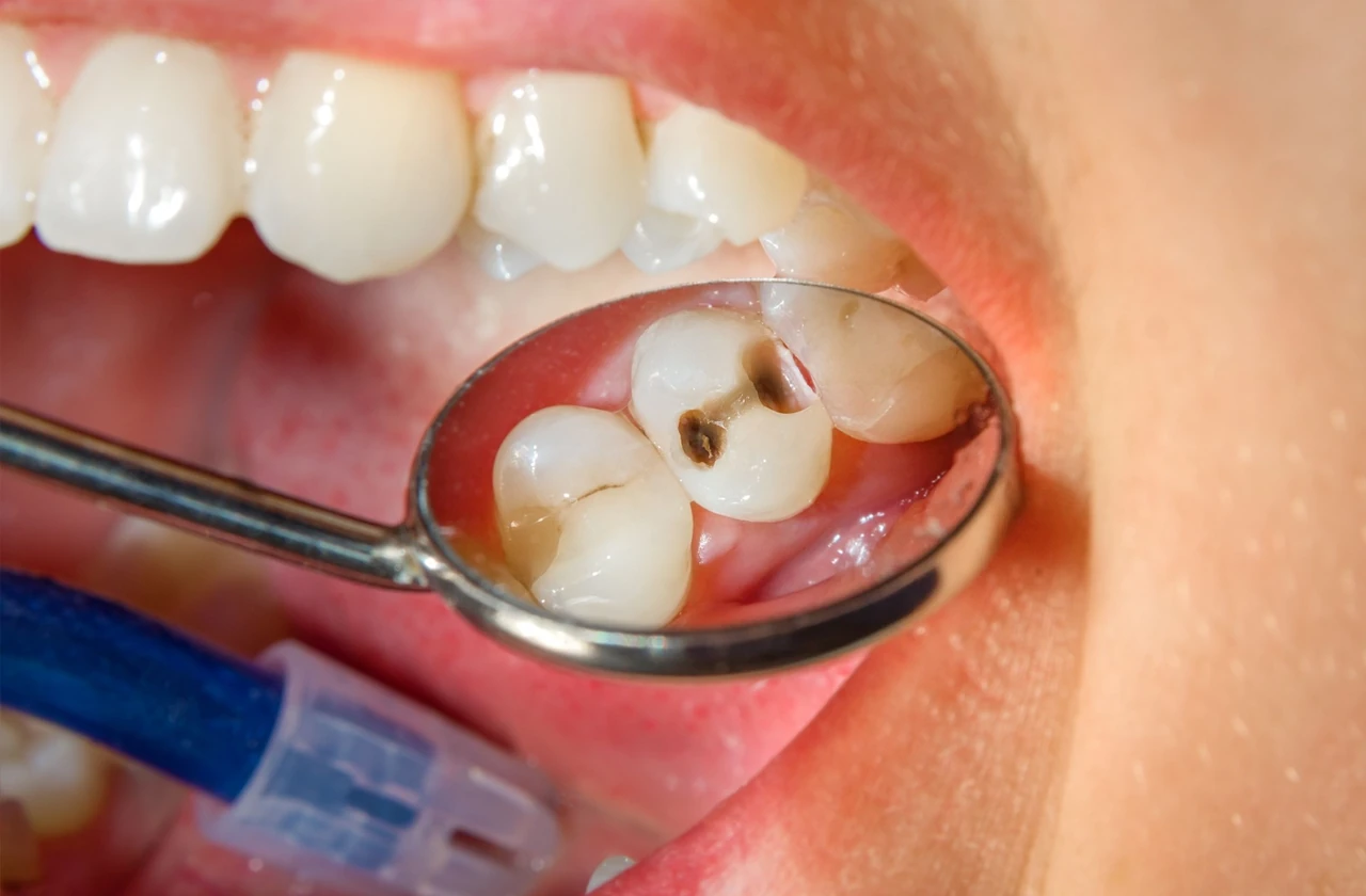 A close up of a dental mirror revealing tooth cavities