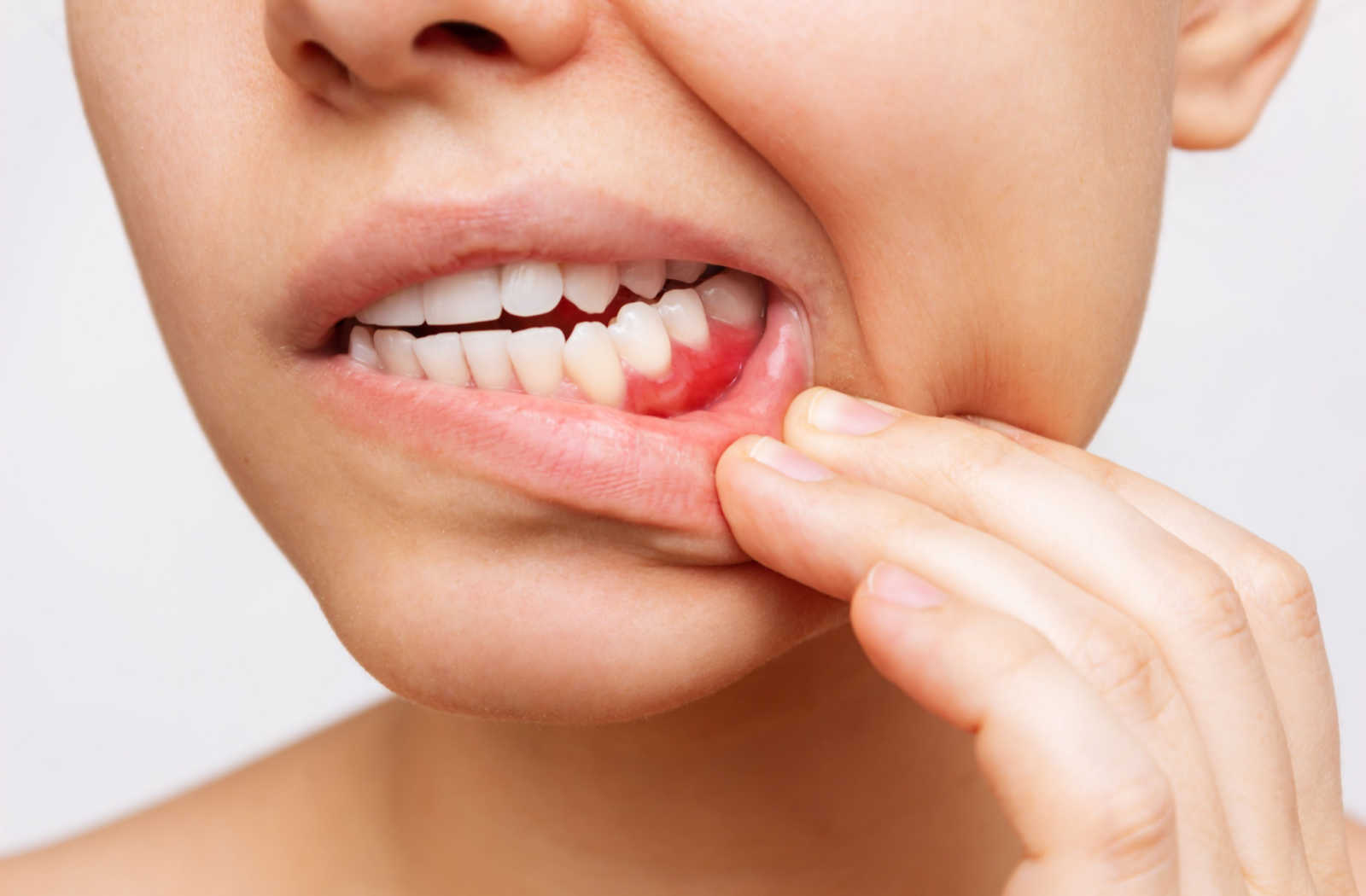 A young woman pulling her lower lip down to reveal her bleeding gums.