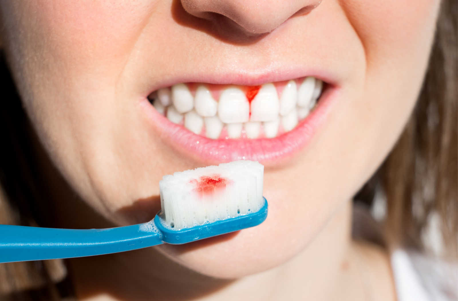 A close-up of a woman's teeth with bleeding gums while she brushes her teeth.