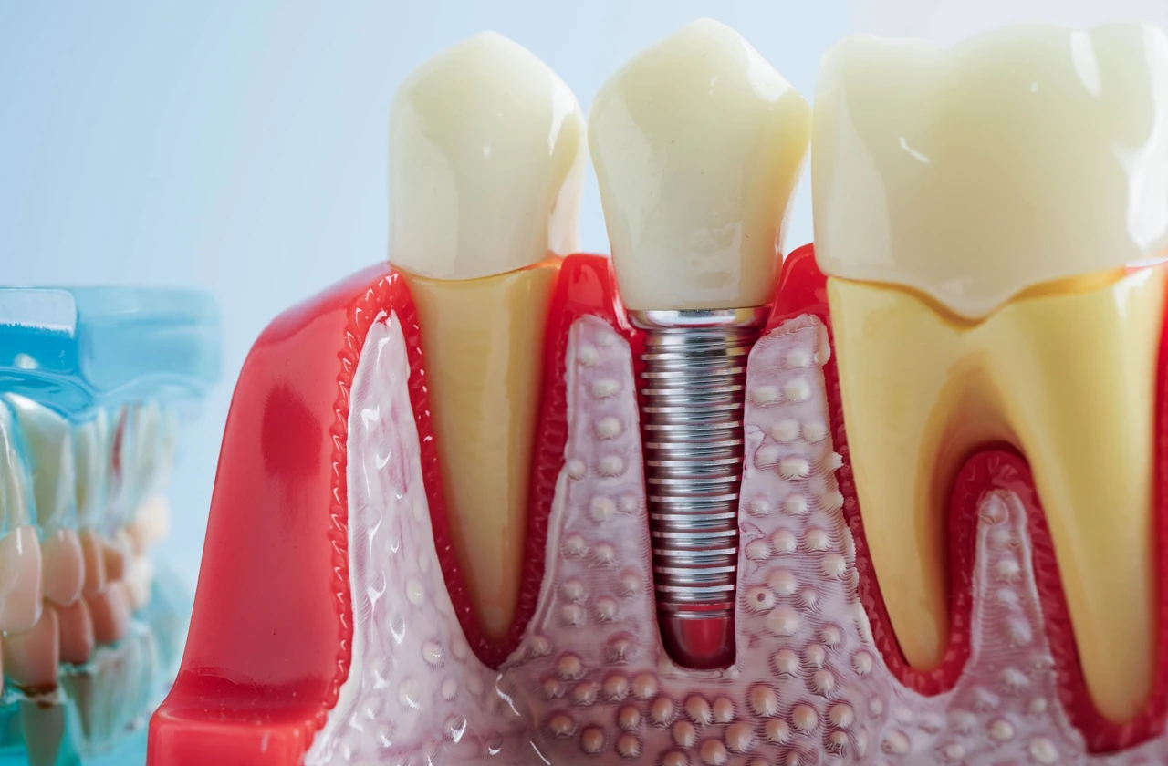 Close-up of a model of a mouth showing a dental implant with a crown on top.