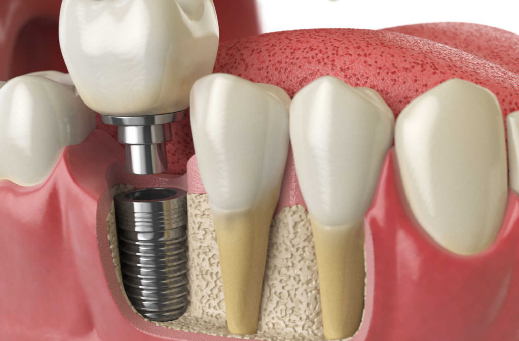 An illustration of what a dental implant looks like.