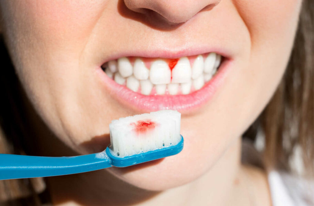 A close-up of a woman's teeth with bleeding gums while she brushes her teeth.