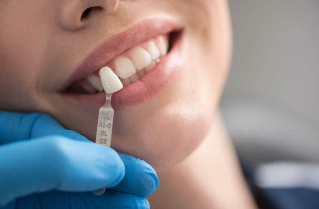 A dentist holding a veneer close to a female patient's teeth to find the right size and shade of porcelain veneer for her.