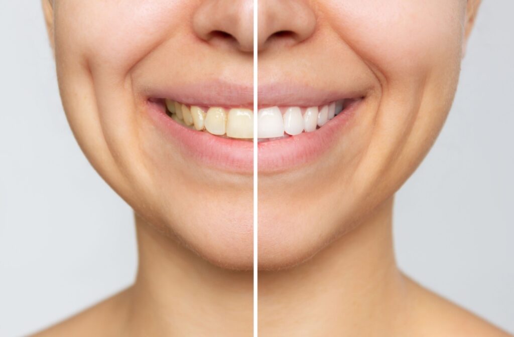 A before and after teeth whitening image of a woman's teeth