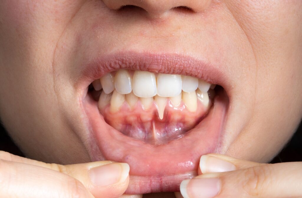 Close up of someones mouth, showing receding gums.