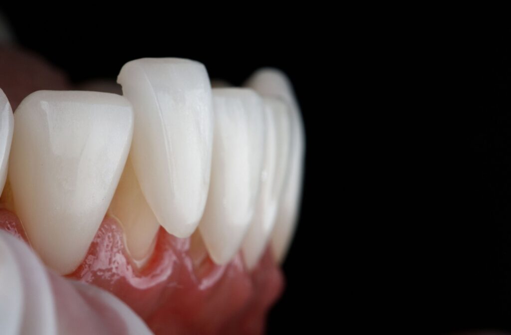 A close-up showing how porcelain veneers cup over teeth for natural-looking results.