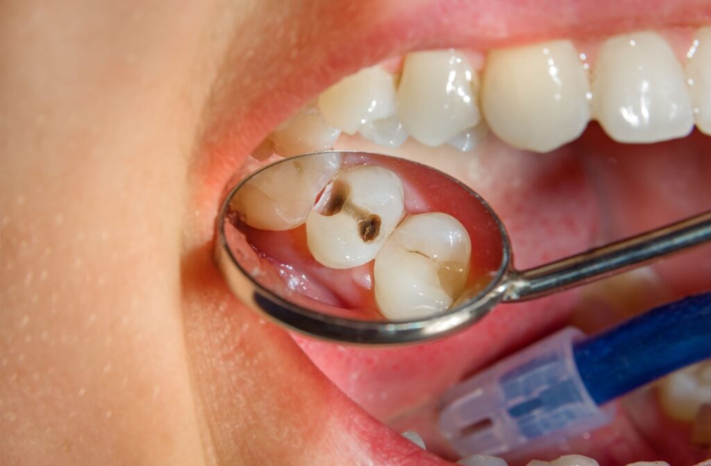 A dental mirror magnifies a patient's tooth decay.