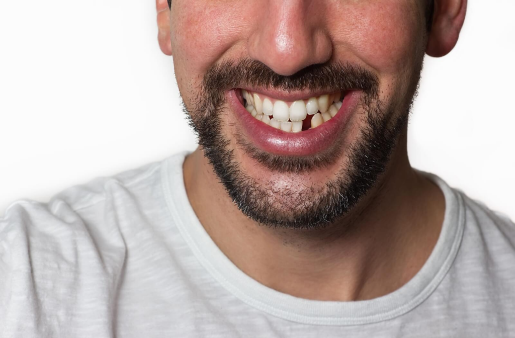 Close-up of an adult smiling with a missing tooth near the front; eyes are not visible.